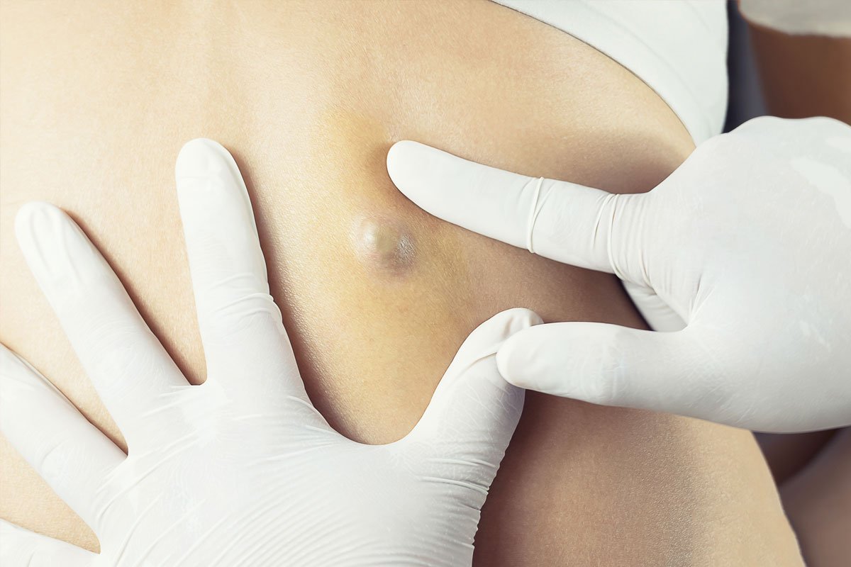 What Should You Expect From Cyst Removal?